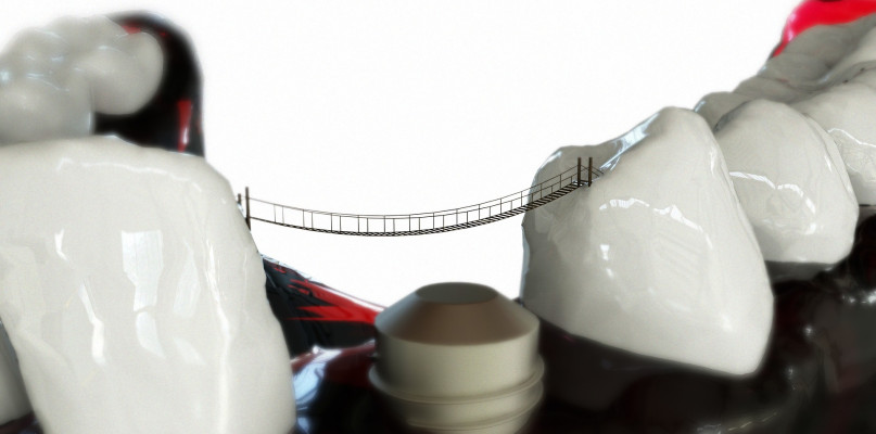 Korona porcelanowa na Żoliborzu? ? poznaj dostępne rodzaje koron protetycznych