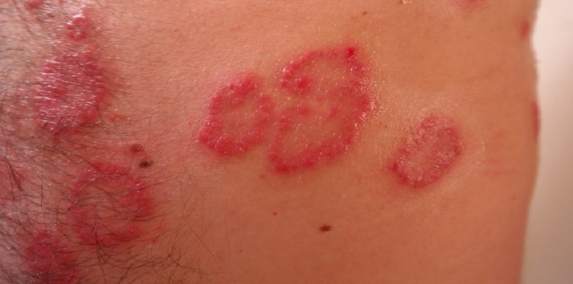 Kremy na łuszczyce ? gdzie kupić?