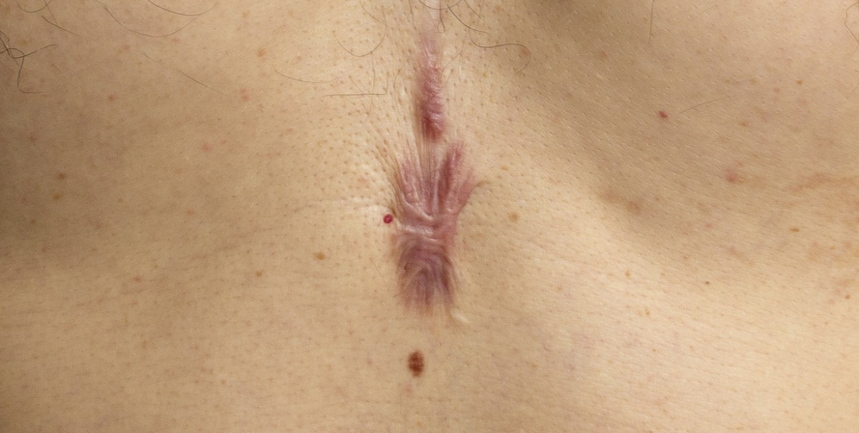 Usuwanie blizn Wrocław: Skuteczne rozwiązania dla pięknej skóry 