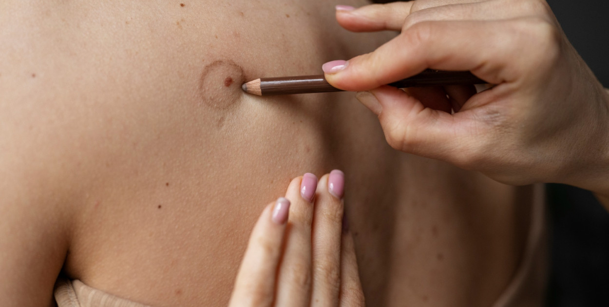 Usuwanie pieprzyków Łódź: Jak przygotować się do zabiegu – praktyczne porady