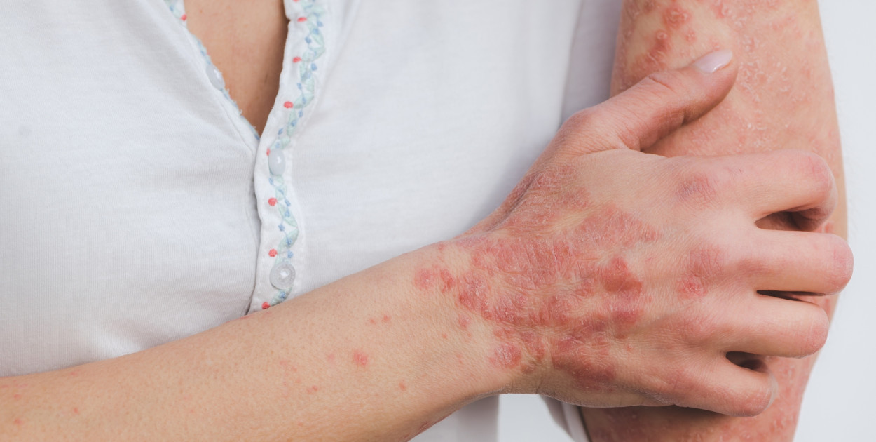 Atakuje coraz częściej. W Wielkopolsce liczba chorych wzrosła czterokrotnie